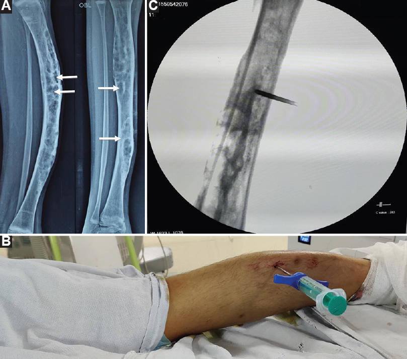 (A) Plain radiograph (lateral and oblique views) showing deformed right tibia with multiple lytic sclerotic lesions (arrows) giving a ground-glass appearance suggestive of fibrous dysplasia. (B) Photograph showing Jamshidi needle inserted into the right leg. The right leg looks deformed. (C) Fluoroscopy image showing flow of zoledronate mixed with radio-opaque contrast into the right tibia.